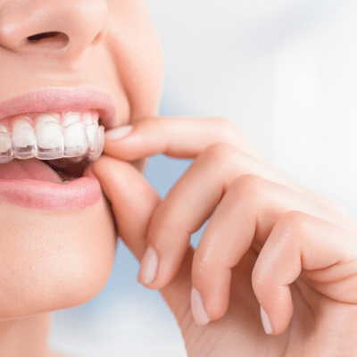 Person inserting invisalign aligner in mouth, representing what to expect when starting invisalign